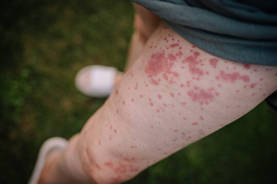 Close-up of a woman's leg showing a rash caused by Human Parvovirus (Parvovirus B19), standing outdoors on grass.