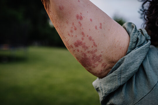 Close-up of a woman's arm showing a rash caused by Human Parvovirus (Parvovirus B19), standing outdoors on grass.