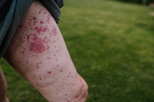 Close-up of a woman's leg with a rash caused by Human Parvovirus (Parvovirus B19), standing outdoors on grass.
