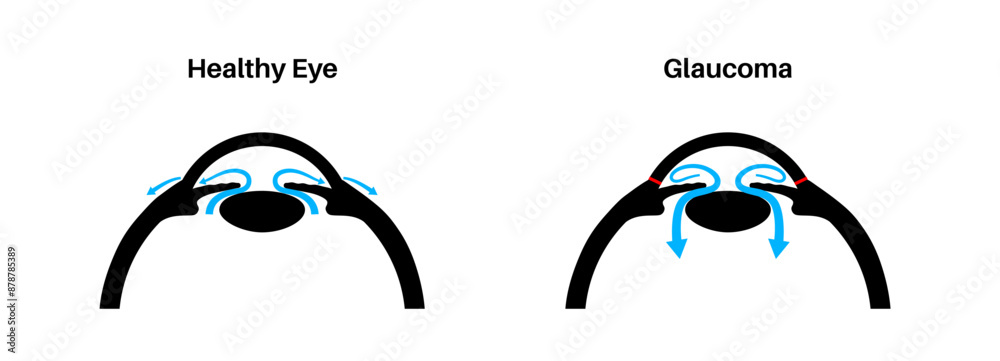 Sticker Glaucoma eye pressure