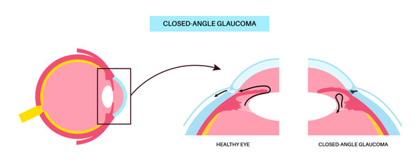 Glaucoma eye disease
