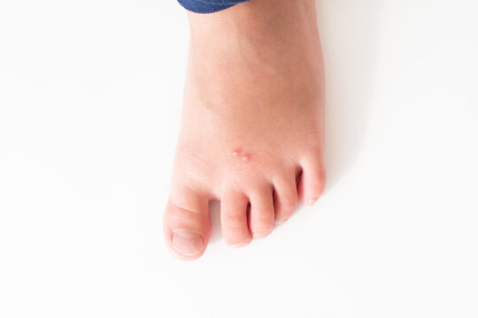 The Foot of a kid with an insect bite. Fire ant bites
