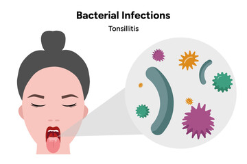 Bacterial infection tonsillitis 