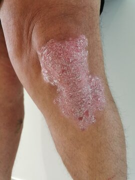 Psoriasis sur genou