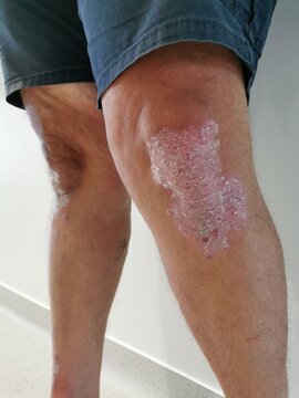 Psoriasis du genou