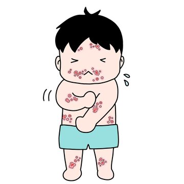伝染性膿痂疹（とびひ）にかかった子どものイラスト
