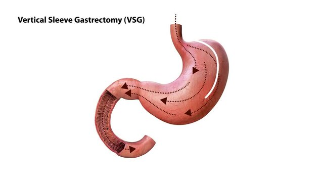 Laparoscopic Sleeve Gastrectomy Logo, Vertical Gastrectomy Logo , Weight loss surgery 3d animation of Stomach reduction logo surgery, vertical