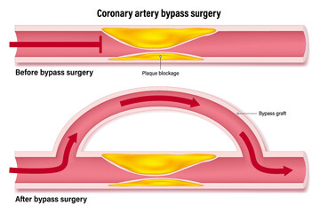 Coronary artery bypass of the human heart. Blood vessels that have accumulated fat causing blockage of plaque and blood vessels after bypass surgery.