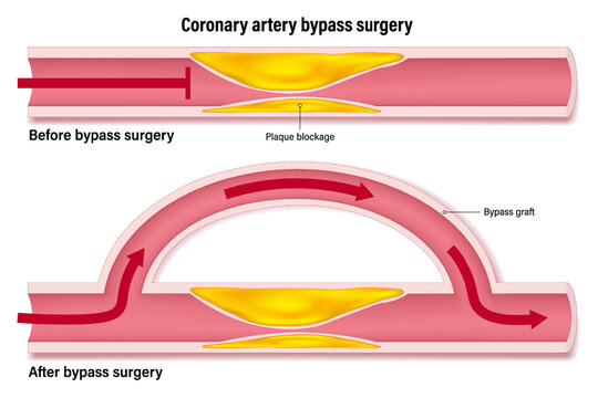 Coronary artery bypass of the human heart. Blood vessels that have accumulated fat causing blockage of plaque and blood vessels after bypass surgery.