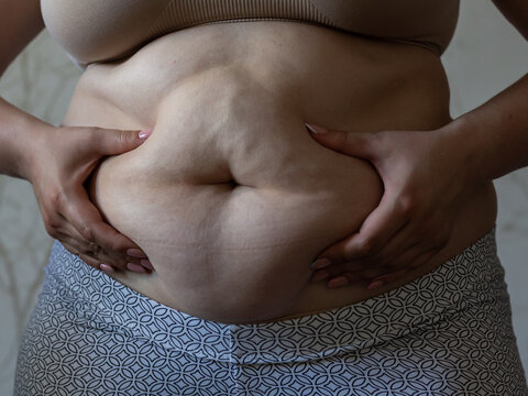 Woman belly fat dissolving treatment. Cushing syndrome weight gain. Pendulous Abdomen. Body after pregnancy.