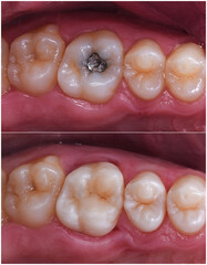 amalgam filling safe repacment with light cure esthetic composite filling