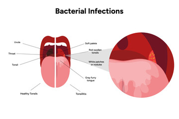 Bacterial infection tonsillitis 
