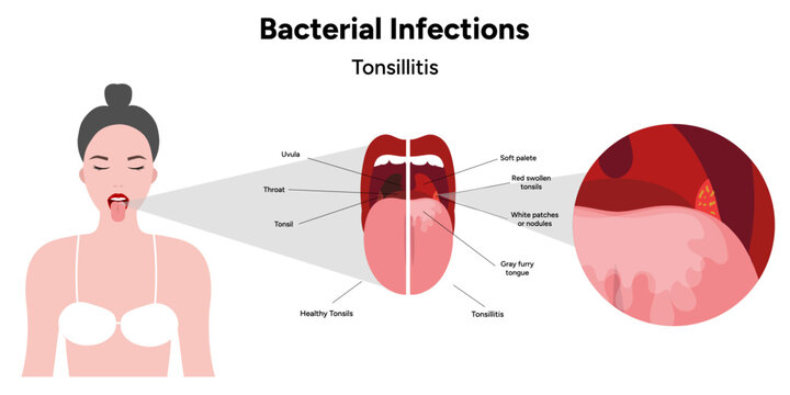 Bacterial infection tonsillitis 