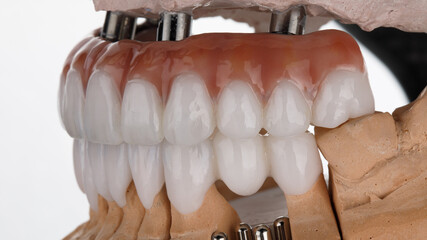 upper jaw prosthesis made of zircon and lower jaw crown on models, side view on a white background