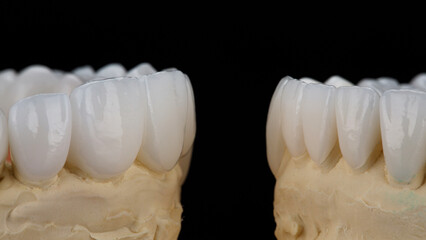 macro dental photograph of veneers on the upper and lower incisors on a black background
