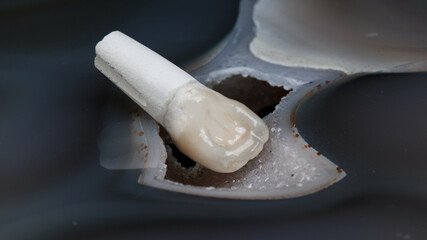 beautiful morphology of a ceramic crown on natural stone with crystals