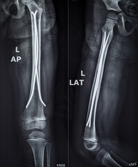 X ray of thigh shows fixation of paediatric femur fracture with subcutaneous k wire  