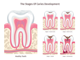Caries stages. Human decay teeth progress, dental problem oral cavity gum infection abscess pulpitis dead tooth root canal disease periodontal erosion, swanky illustration