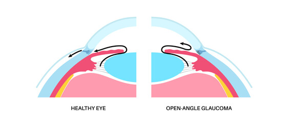 Glaucoma eye disease
