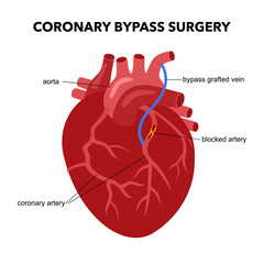 Coronary artery bypass surgery in flat design on white background.