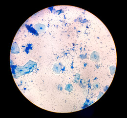 Photomicrograph showing Hyphae of dermatophytes, Nail scraping or skin scraping for fungus test in microbiology laboratory.