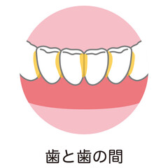 歯と歯の間に溜まった歯垢　歯磨き　磨き残し