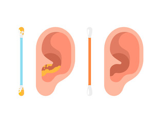 Human ear and ear stick. Ear cleaning stick