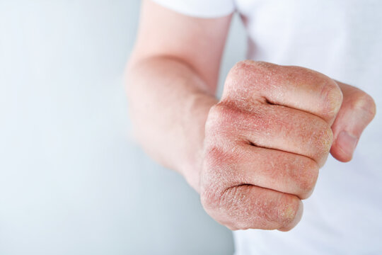 Man scratches or shows hands with dry, cracked skin on white backgrounds. Problem with many people - eczema on hand, allergies or dry skin. Health care concept. Close up.