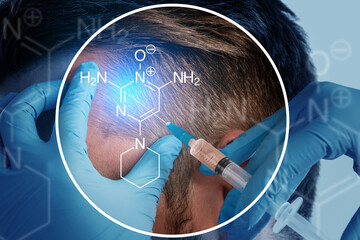 Man Receiving Scalp Injection of Minoxidil for Hair Growth Treatment