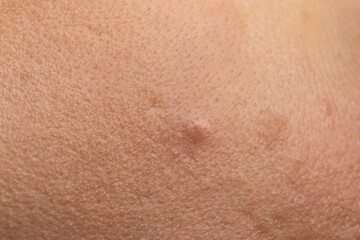 Fototapeta premium Close up showing skin suffering from acne