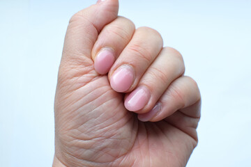 Overgrown manicure with gel and very dry cuticles. Female wrinkled hand with pink gel polish before correction in a beauty salon.