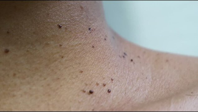 Close up the skin tags on woman's neck. Acrochordon. Health care concept. Woman showing her neck's skin with skin tag.