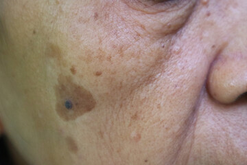 Fototapeta premium Age spots with lentigo maligna, eye bags and smile line on the old woman's cheek. an early form of pre-invasive melanoma in which cancer cells are confined to the top layer of the skin.