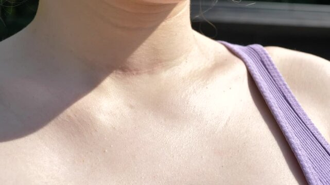 Thyroid removal scar on caucasian womans throat