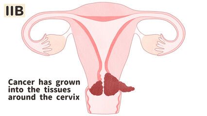 Cervical cancer stage 2B diagram PNG