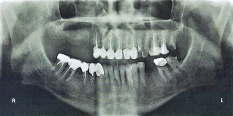panoramic radiography teeth , x-ray data for the dentist