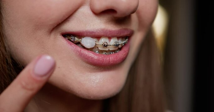 Close-up image of young woman showing dental braces emphasizing orthodontic treatment. Concept of dental health, oral hygiene and self-esteem. Focus on woman's mouth and braces. Braces, Dental Care.