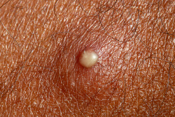 Infected hair follicle forming a pustule on human skin