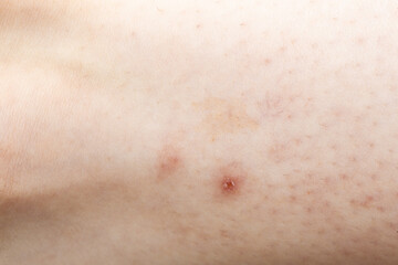 Naklejka premium Close up of skin showing signs of chickenpox virus