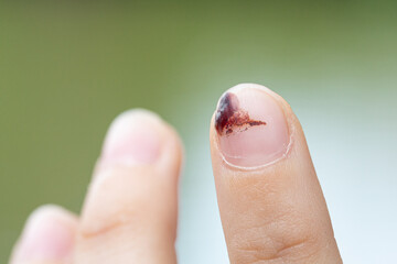 Close up of injured fingernail with blood clot forming under nail
