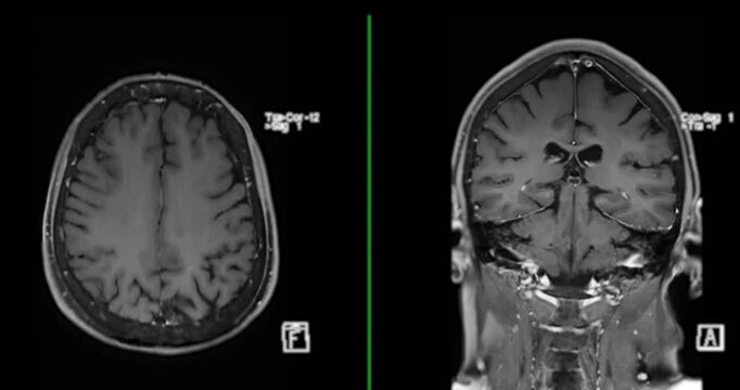 The MRI brain scan footage reveals intricate brain details, aiding in diagnostic procedures.