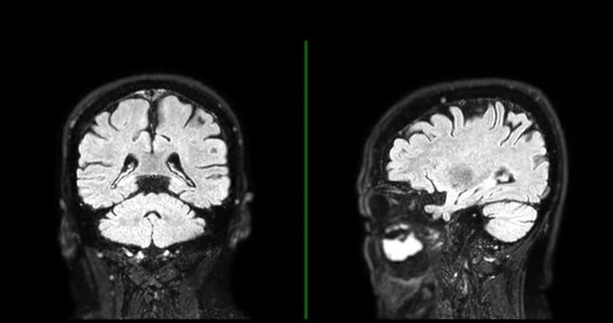 The MRI brainT2 flair sequence  scan footage reveals intricate brain details, aiding in diagnostic procedures.