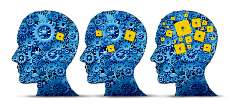 Alzheimer's Disease progression and Alzheimer dementia neurodegenerative brain memory loss and mental transforming neurology as a human head with gears and cog wheels.