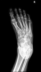 x-ray of foot fractured metatarsal bone. roken foot, oblique view, show fracture of 1th metatarsal...