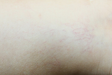 Fototapeta premium Spider veins on the leg