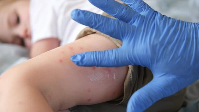 Doctor examining child with bodily red rash. Kid allergy closeup. Little baby scratches an eruption. Nurse applies special cream to atopic skin. Dermatitis, irritation, hive. Pruritus. Mosquito bites