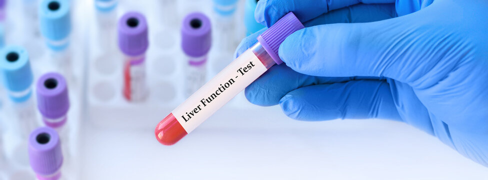 Doctor holding a test blood sample tube with liver function test on the background of medical test tubes with analyzes.