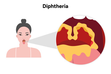 Diphtheria woman open mouth with throat zoom