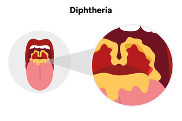 Diphtheria open mouth with throat zoom