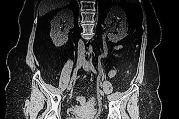 Medical themes: Abdominal tomography showing bilateral renal lithiasis. Bilateral hydronephrosis